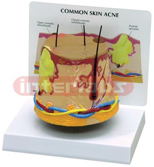 Skin Acne